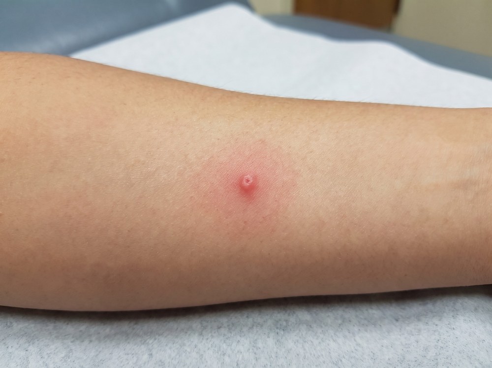 Close-up of a mild red bite mark with slight swelling on skin resembling a small insect bite