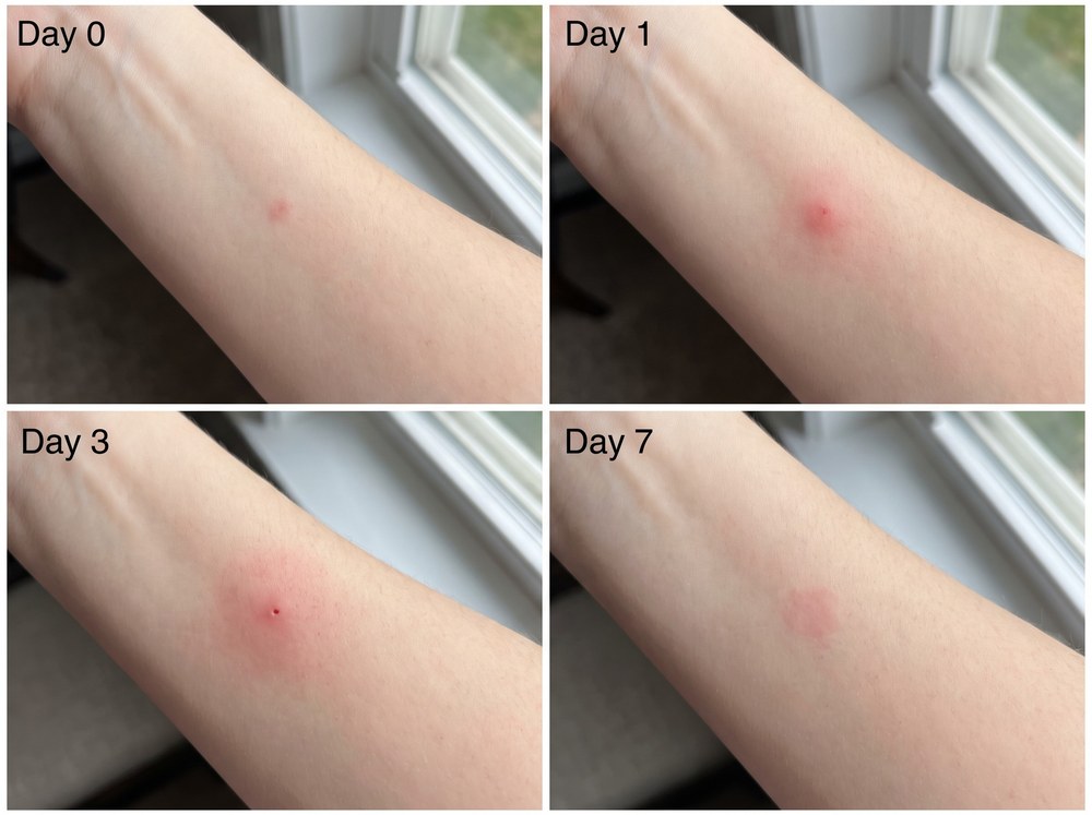 Four-panel progression photo showing a mild spider bite mark fading from Day 0 through Day 7